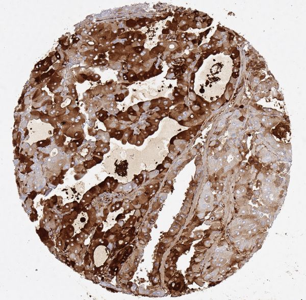 Papillary thyroid carcinoma with mosaic-like cytoplasmic staining.